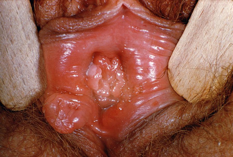 Superficial Ulceration On The Vulva