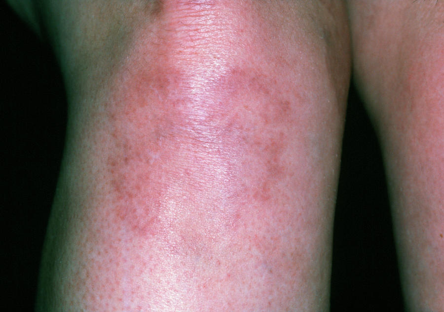 Systemic Lupus Erythematosus Rash On Woman's Leg Photograph by Dr P ...