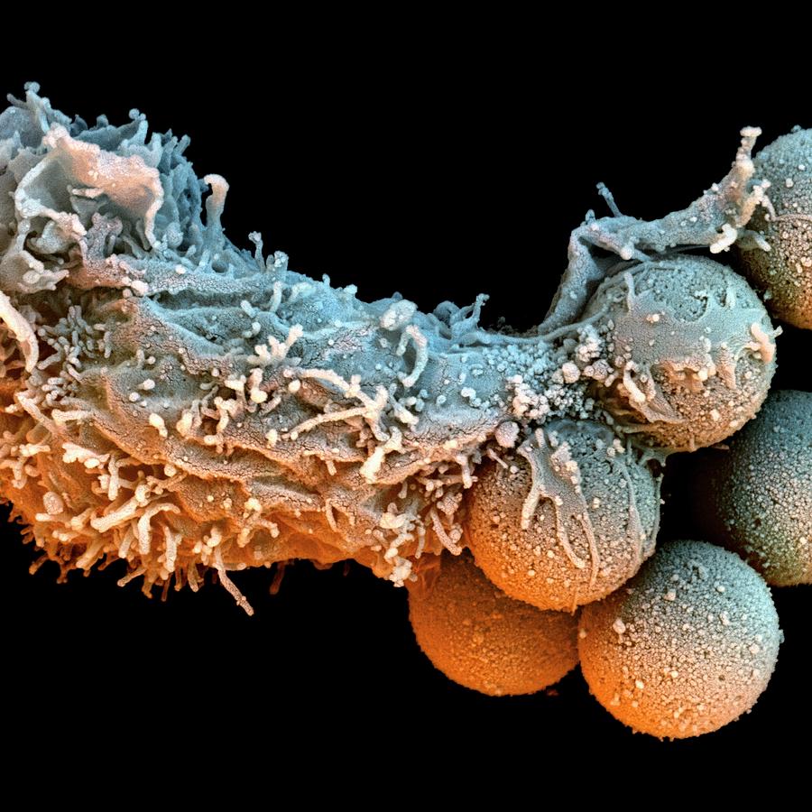 T Lymphocyte Photograph - T-lymphocyte And Iron Particles by Stefan Diller