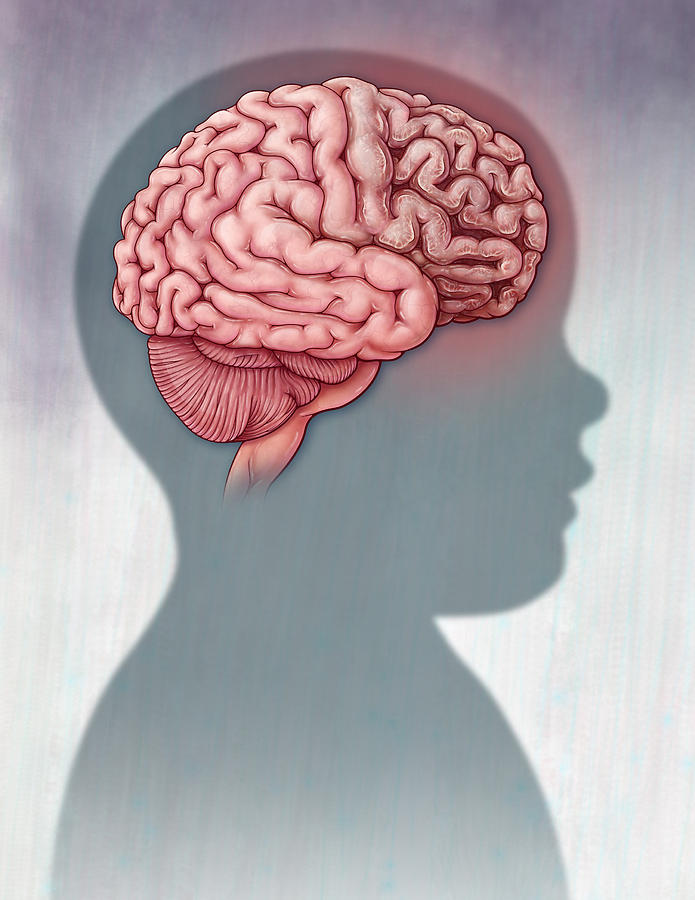 Tay-sachs Disease, Brain Anatomy by Evan Oto