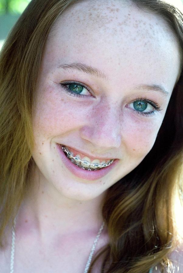 Teen Freckles