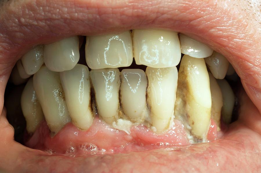 Teeth Covered With Plaque And Tartar Photograph By Dr Armen Taranyan 