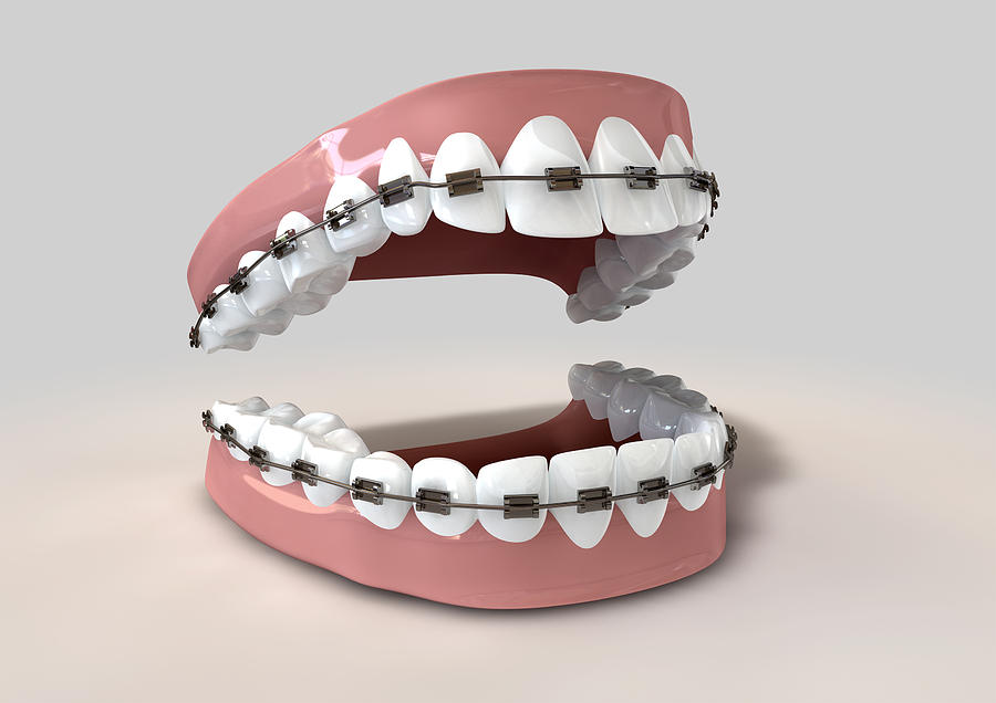 Teeth Digital Art - Teeth Fitted With Braces by Allan Swart