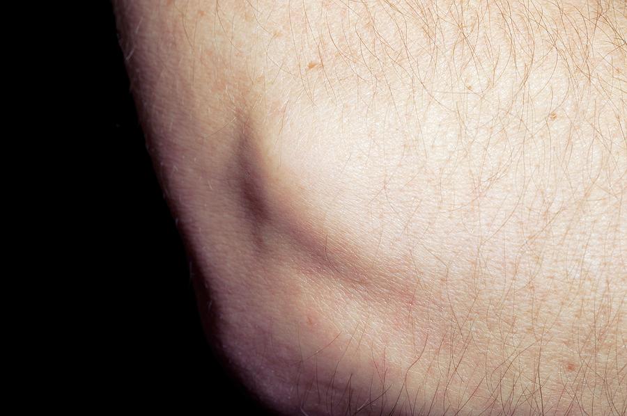 Tennis Elbow Swelling Photograph by Dr P. Marazzi/science Photo Library