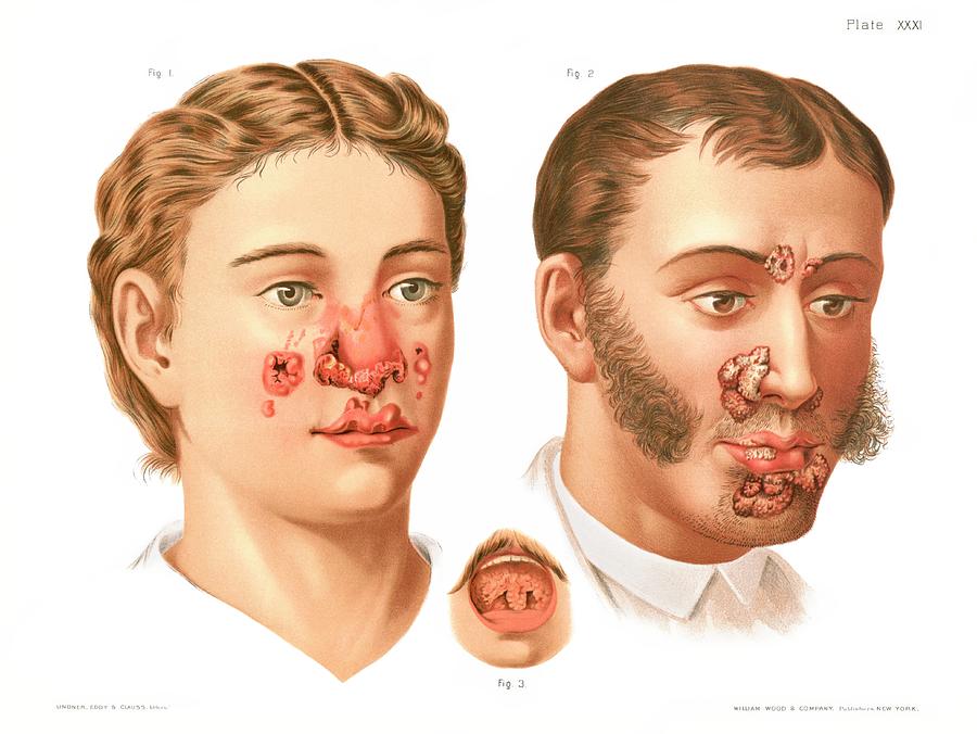 Tertiary Syphilis Lesions Photograph by Us National Library Of Medicine/science Photo Library