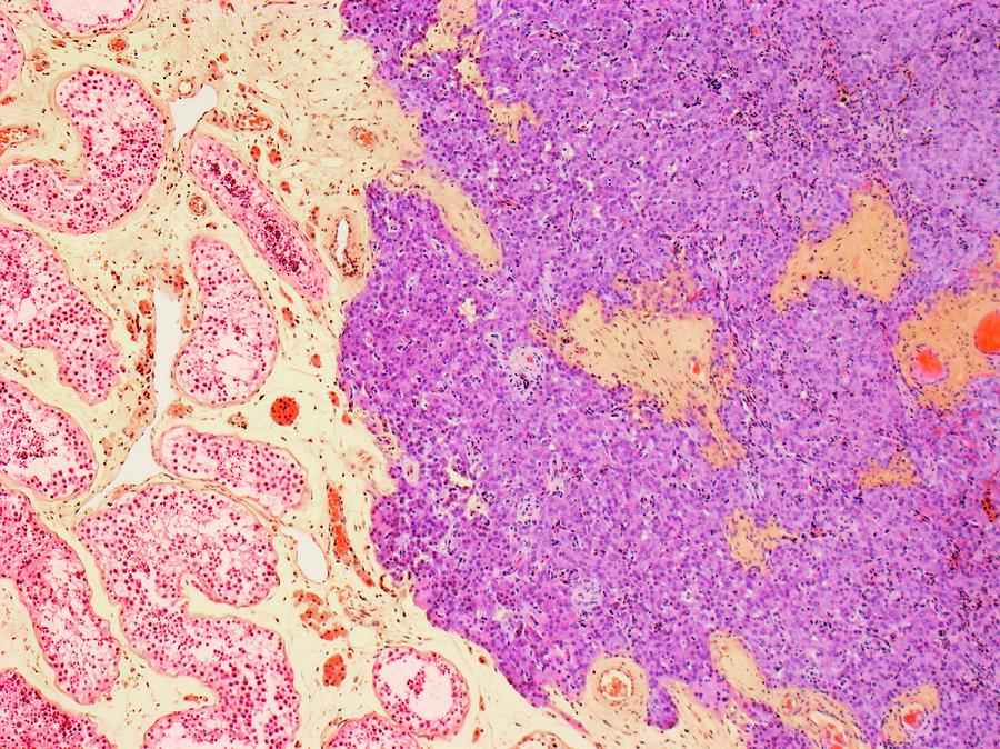Biopsy Photograph - Testicular Tumour by Steve Gschmeissner