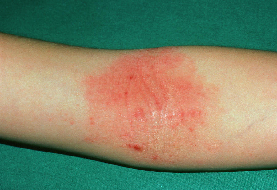 The Elbow Of A Patient Affected By Atopic Eczema Photograph By Dr P
