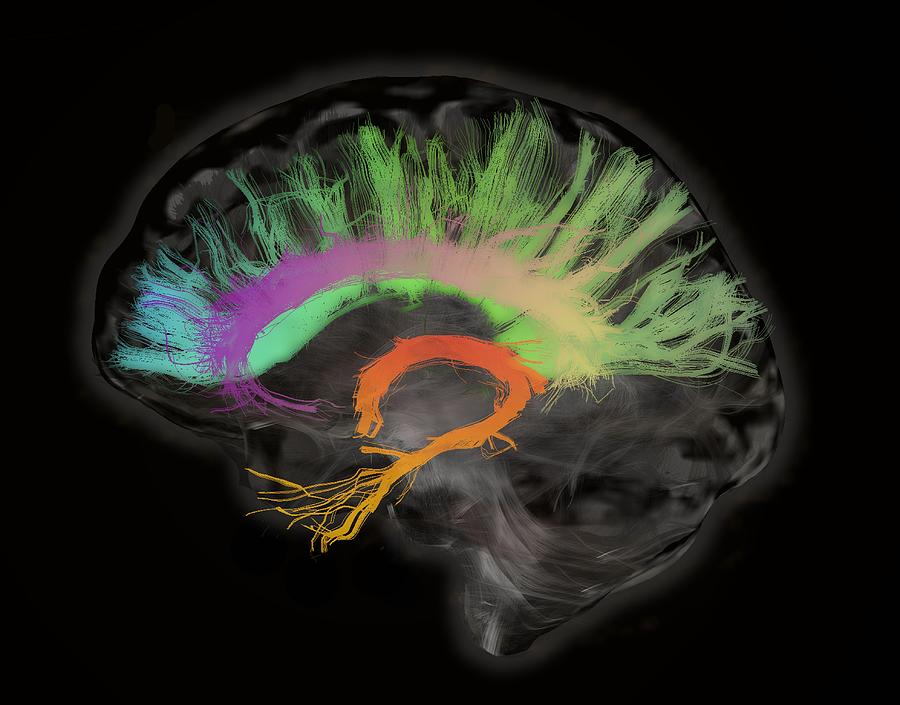 The fiber tracts involved in aging. The splenium and genu of the corpus callosum, the fornix and the cingulum bundle. Human subject Photograph by Sherbrooke Connectivity Imaging Lab (SCIL)