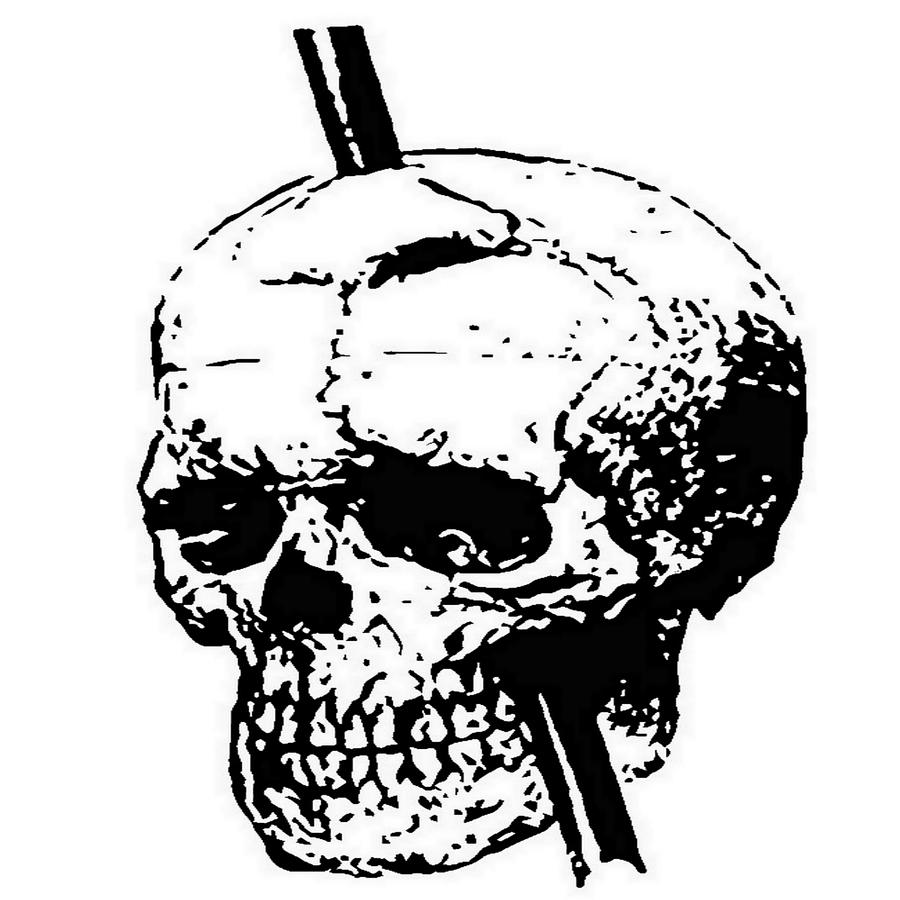The Skull of Phineas Gage Vintage Illustration Vector Painting by Taiche Acrylic Art