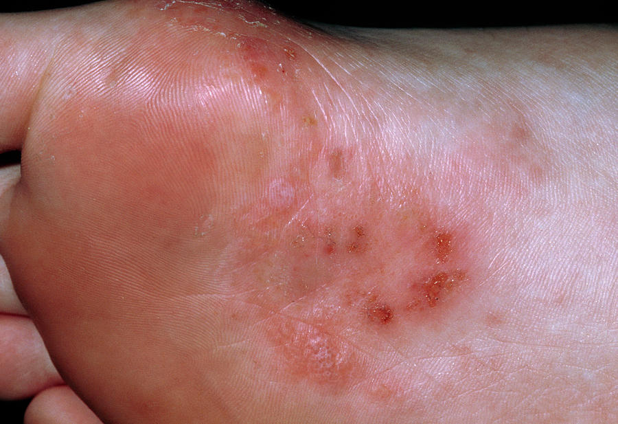 The Sole Of A Foot Affected By Pompholyx Eczema Photograph By Dr P Marazzi Science Photo Library