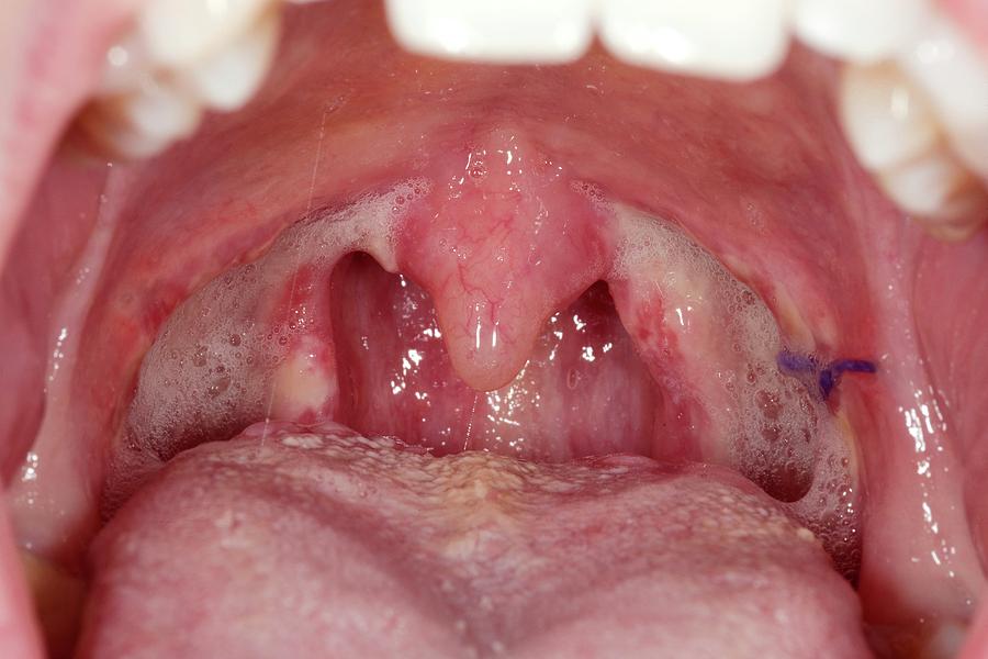 Throat After Tonsillectomy Photograph By Dr P Marazzi Science Photo