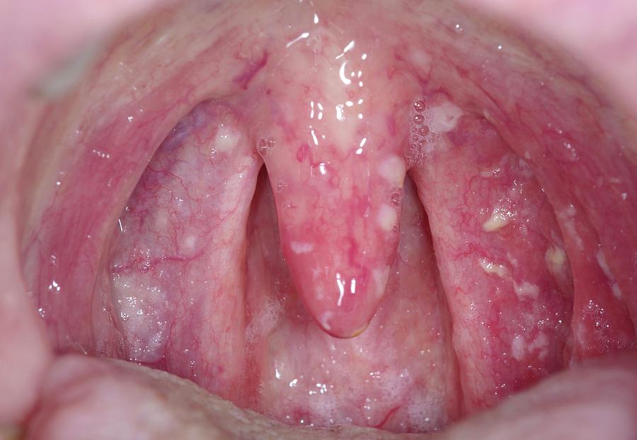 Throat Photograph - Throat Ulcers by David Parker