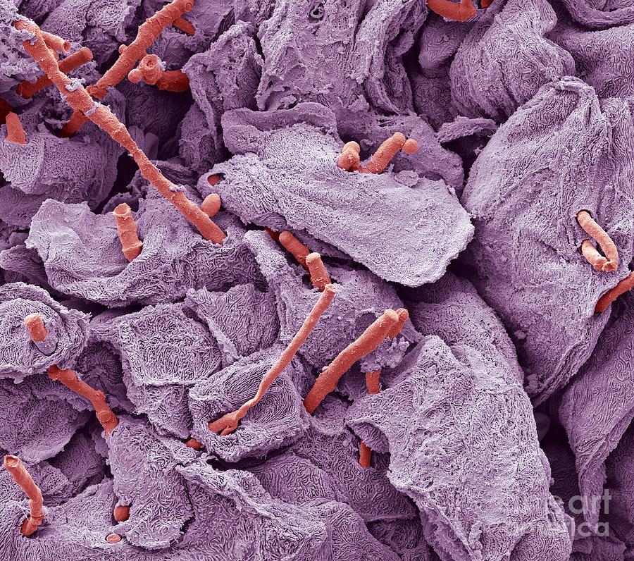 Scanning Electron Micrograph Photograph - Thrush Infection Of The Tongue, Sem by Steve Gschmeissner