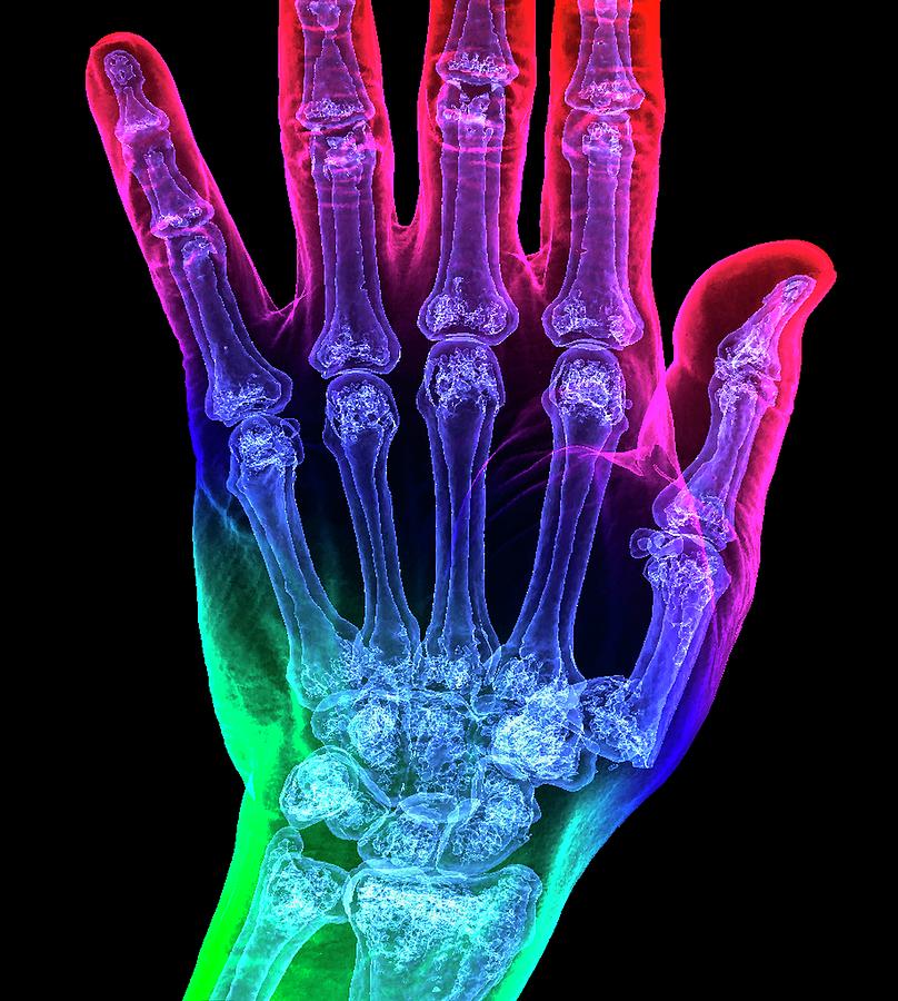 Thumb Fracture Photograph by K H Fung/science Photo Library