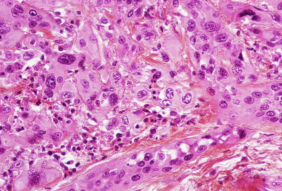 Thyroid Gland Cancer Photograph by Cnri/science Photo Library | Fine ...