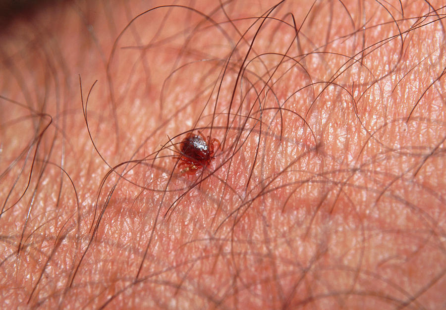 tick-feeding-on-human-skin-photograph-by-sinclair-stammers-science