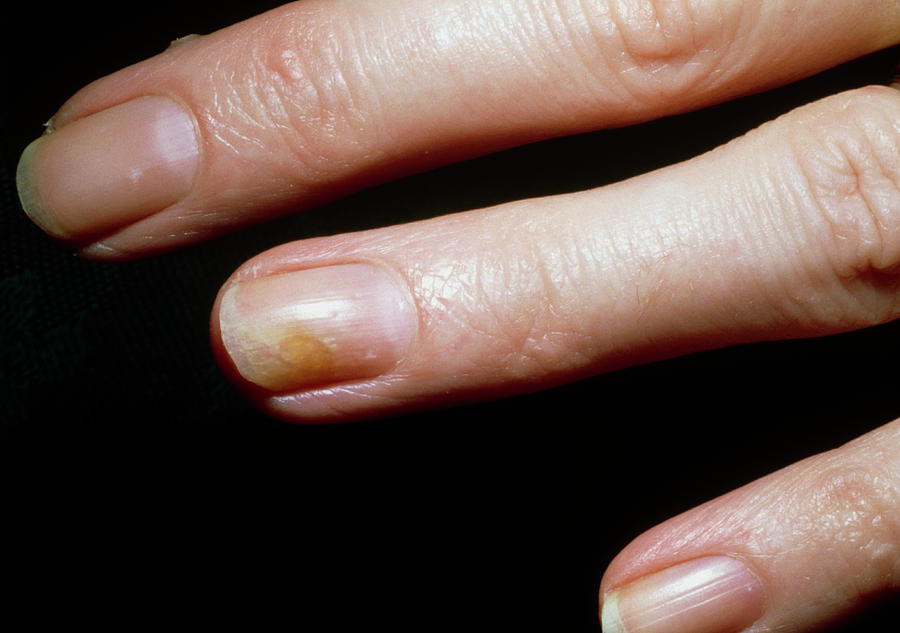 treating-fungal-nail-infections-tips-from-a-singapore-dermatologist