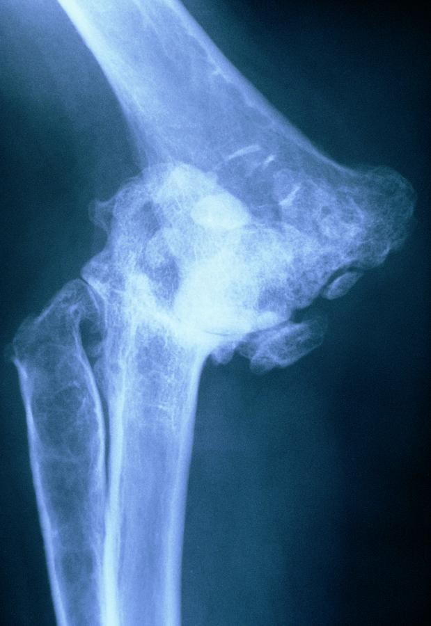 Tinted X Ray Of Elbow With Rheumatoid Arthritis By Medical Photo Nhs Lothianscience Photo Library 0713