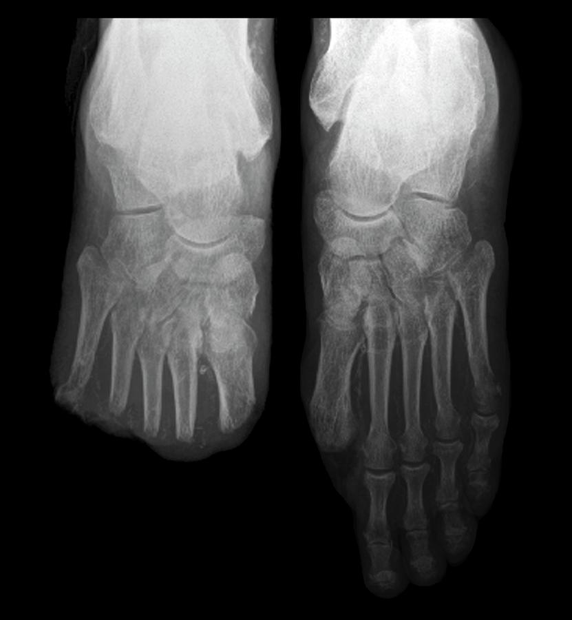Toe Amputations In Diabetes Photograph by Zephyr/science Photo Library