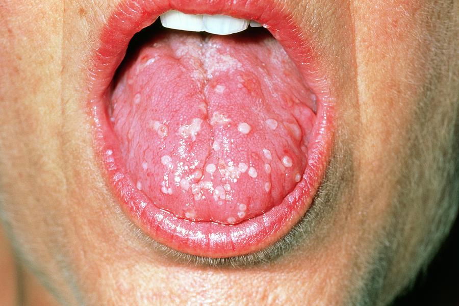 herpes in mouth under tongue