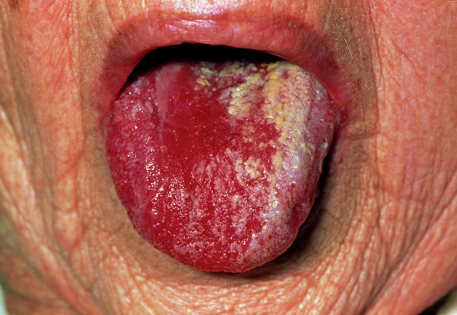 Tongue Of Elderly Woman With Oral Candidiasis Photograph By Dr P