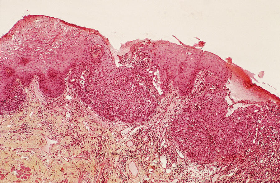 Tongue Tumour Photograph by Cnri/science Photo Library