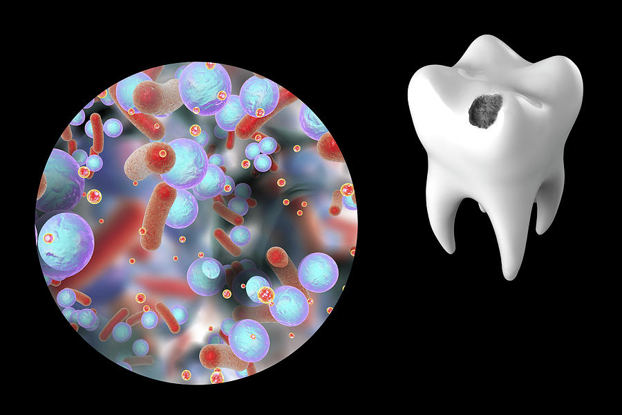 tooth-decay-and-bacteria-photograph-by-kateryna-kon-science-photo-library