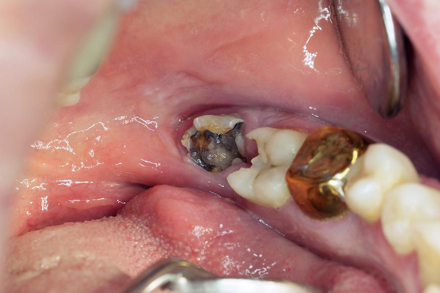 Decayed wisdom tooth.
