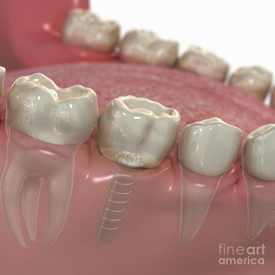 Tooth Implant Lower Jaw Photograph by Science Picture Co
