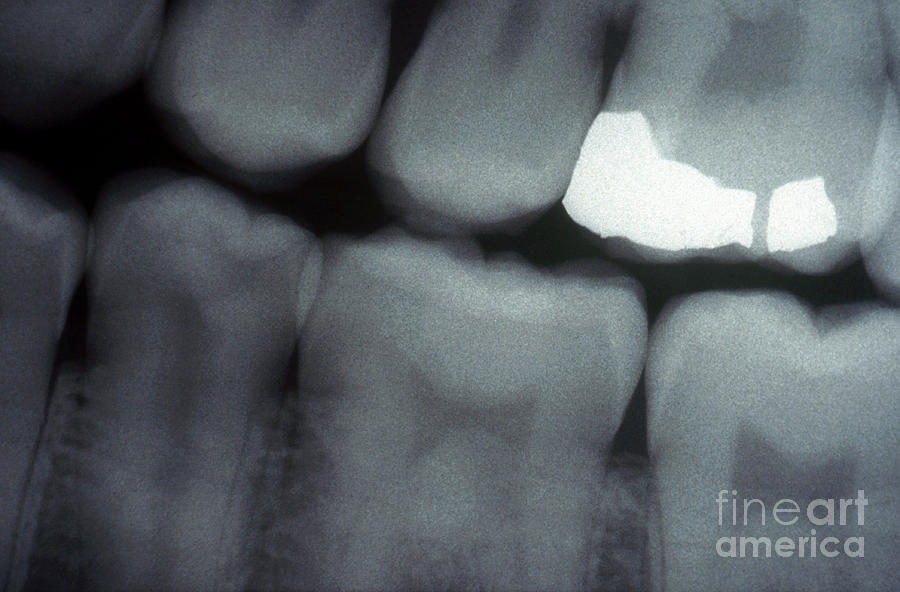 Tooth With Filling, X-ray Photograph by Scott Camazine