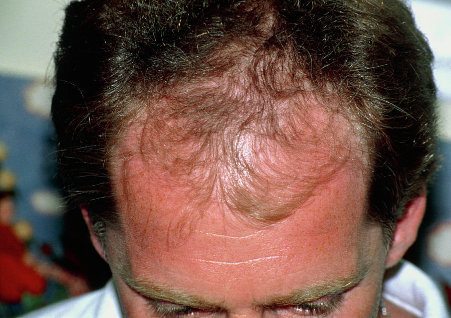 Top View Of Head Of Balding Man Alopecia Photograph By Science