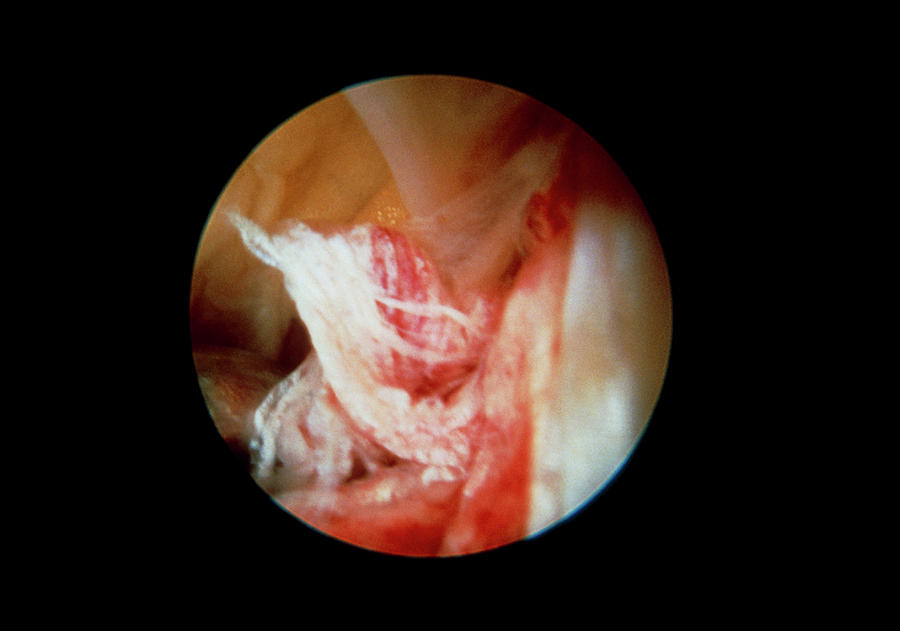 Torn Knee Ligament Photograph by Cnri/science Photo Library