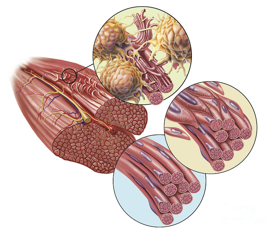 torn-muscle-fibers-with-healing-stages-digital-art-by-trifocal