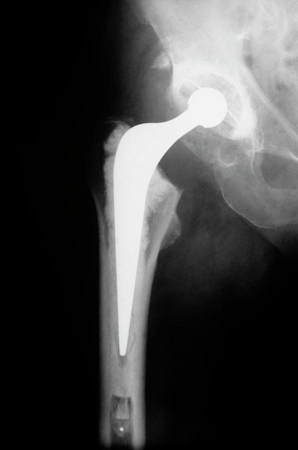 Total Hip Replacement Photograph by Mike Devlin/science Photo Library