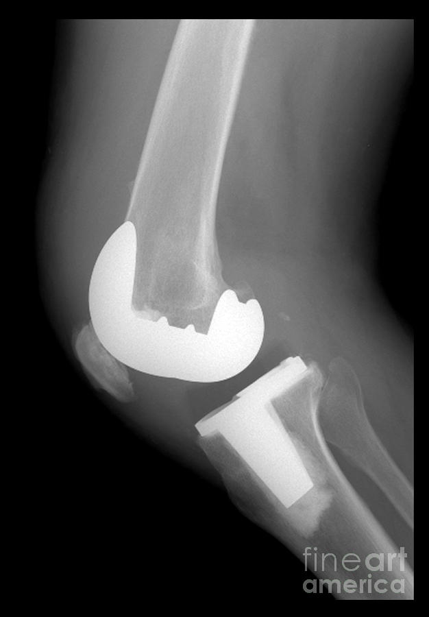 Total Knee Replacement Photograph by Living Art Enterprises