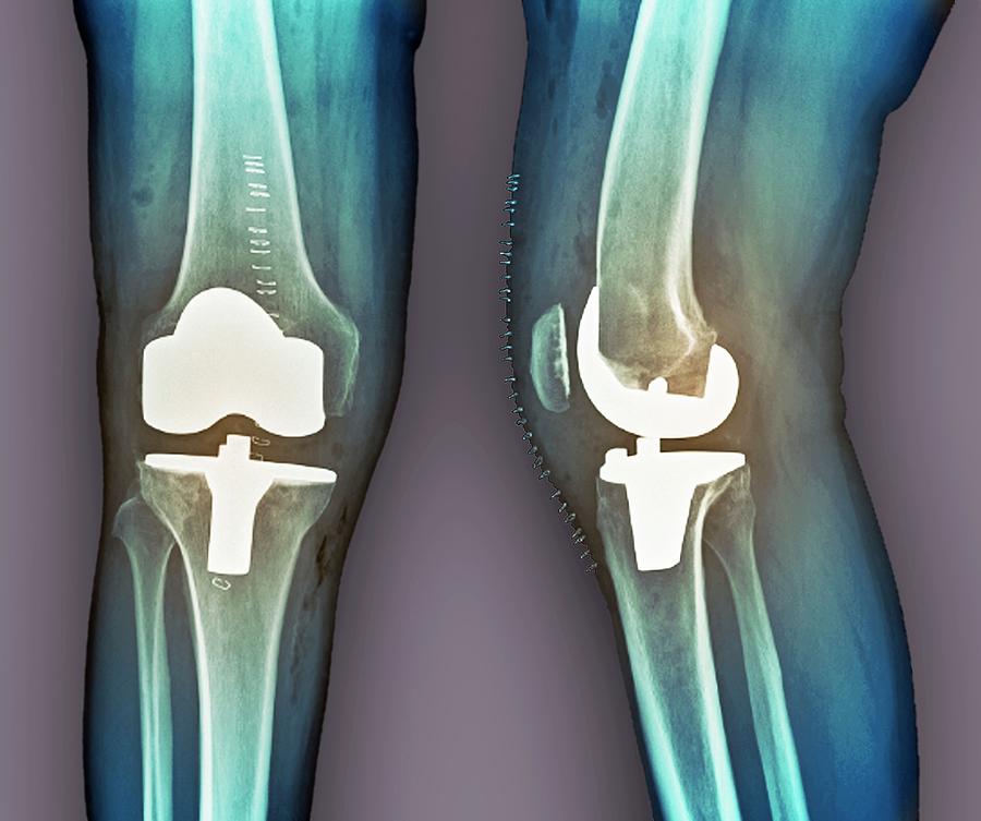 Total Knee Replacement, X-rays Photograph by Zephyr