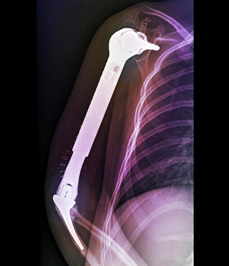 Device Photograph - Total Upper Arm Bone Replacement by Zephyr