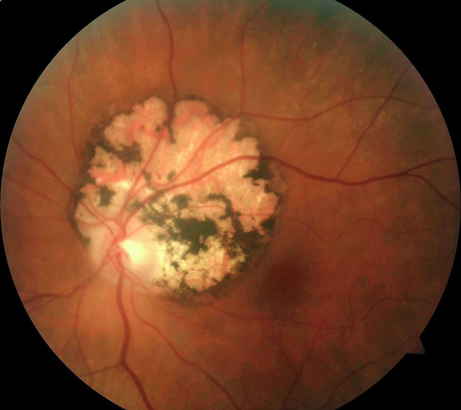 Toxoplasmosis In The Retina Photograph by Mid Essex Hospital Services ...