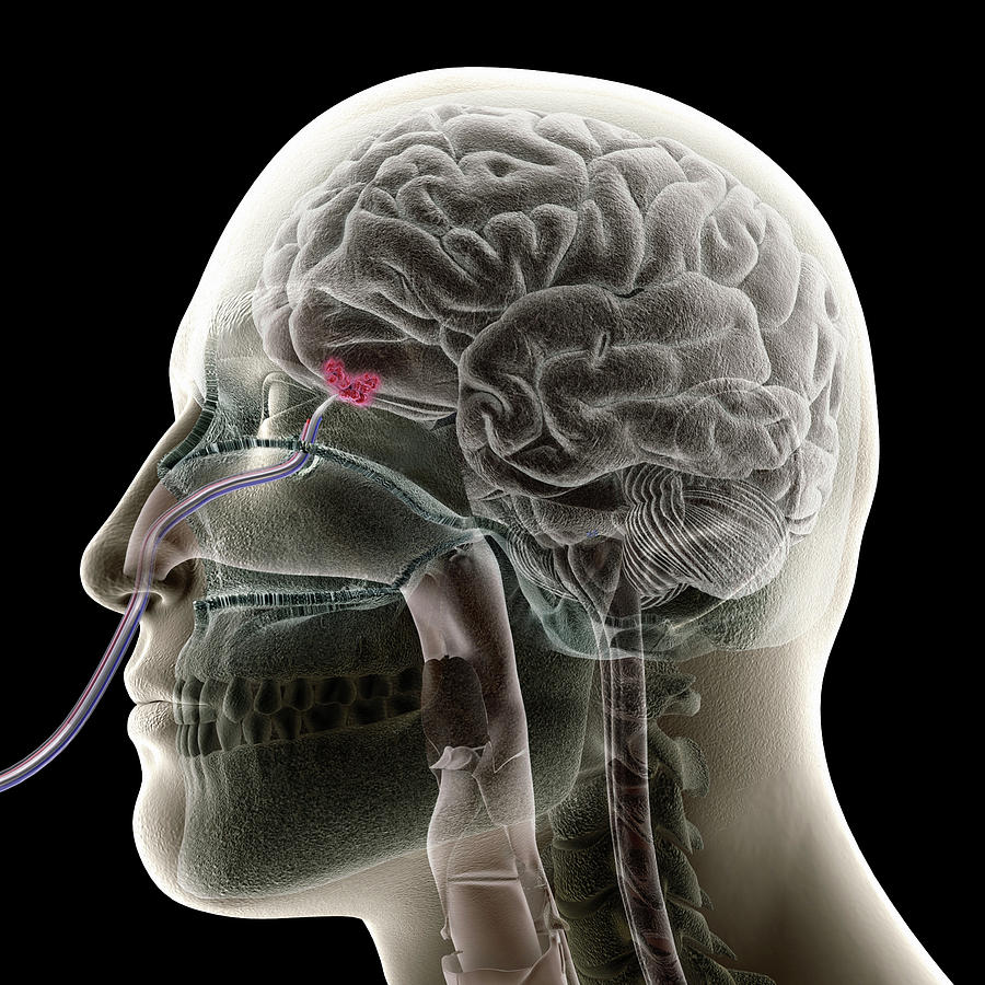 Transnasal Brain Surgery Photograph by Medi-mation/ Science Photo Library