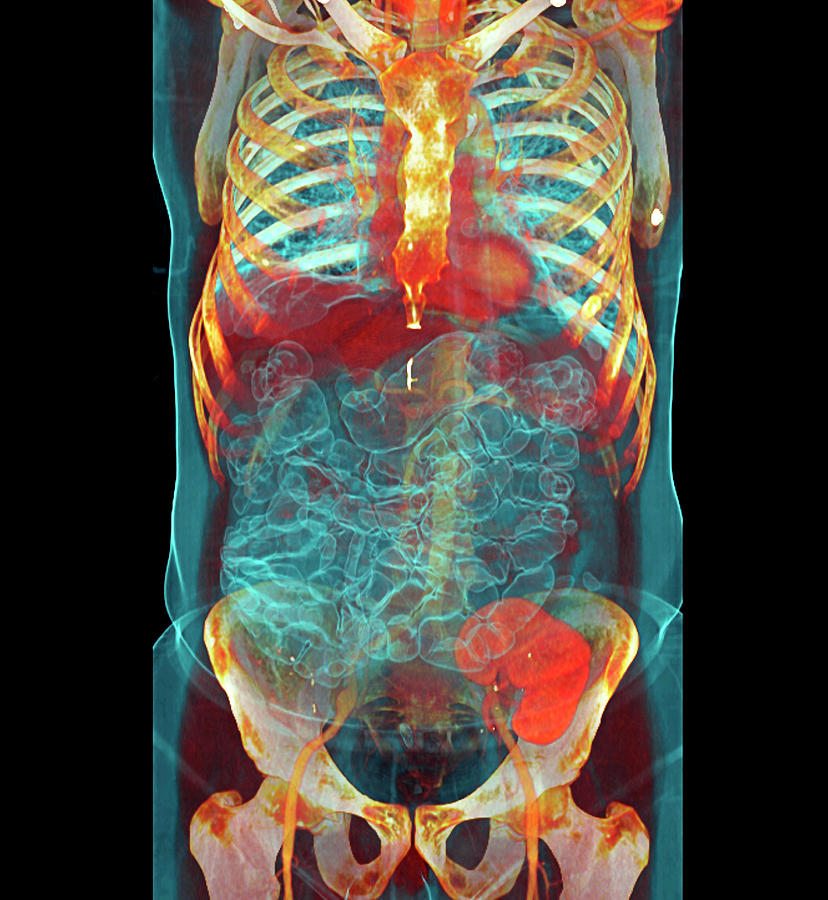 Kidney Photograph - Transplanted Kidney by Antoine Rosset/science Photo Library