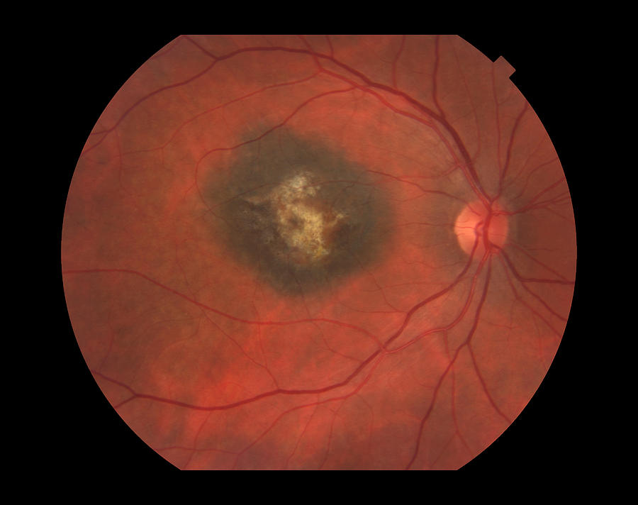 Treated Melanoma, Ophthalmic Medicine Photograph by Paul Whitten