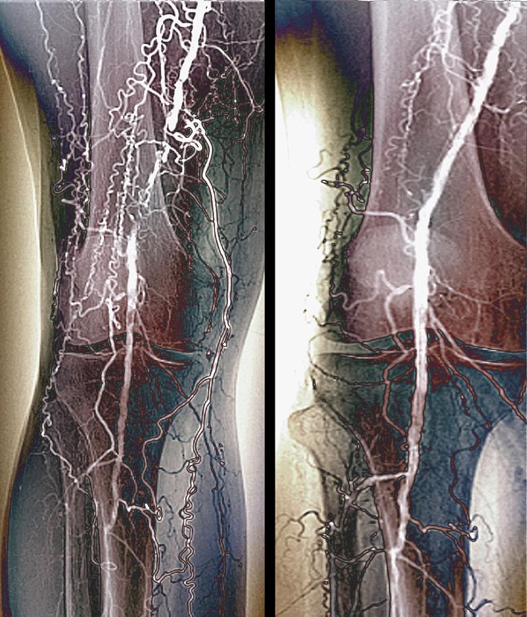 Treatment For Blocked Femoral Artery Photograph by Zephyr/science Photo Library
