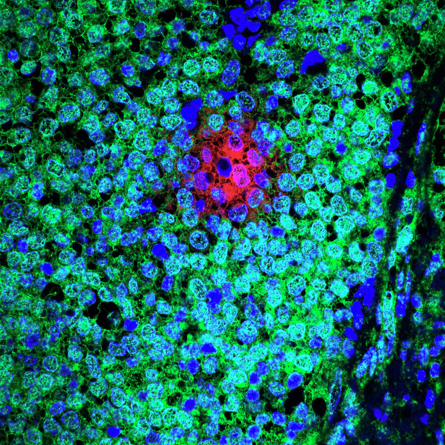 Cell Photograph - Treatment-resistant Breast Cancer Cells by Dana-farber Harvard Cancer Center At Massachusetts General Hospital/national Cancer Institute/science Photo Library
