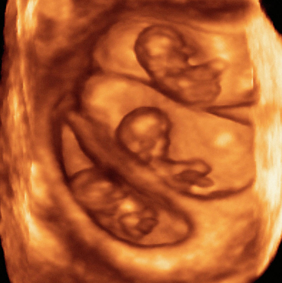 Triplet Foetuses Photograph by Dr Najeeb Layyous/science Photo Library