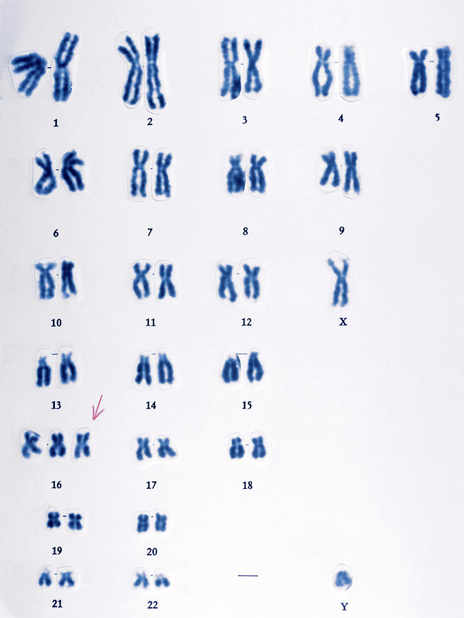 Trisomy 16 Chromosomes Photograph by Cnri/science Photo Library