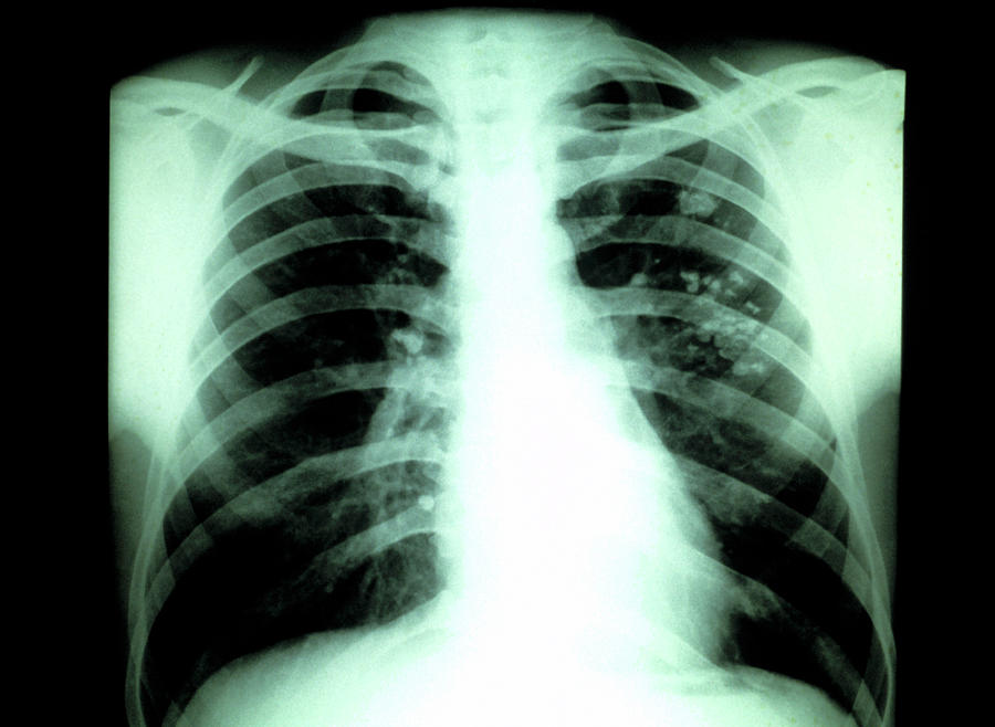 Tuberculosis X Ray Photograph By Cnriscience Photo Library Pixels Merch