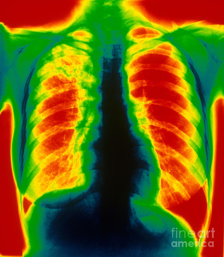 Tuberculosis, X-ray Photograph by Scott Camazine