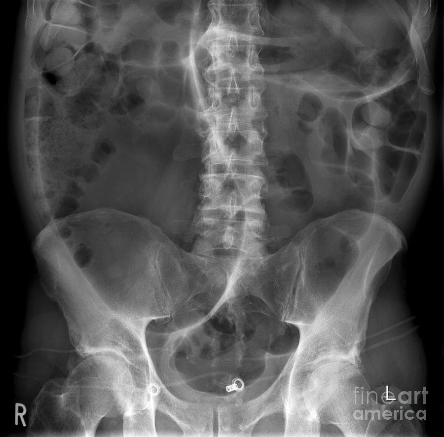 Volvulus Photograph - Twisted Colon, X-ray by Science Photo Library