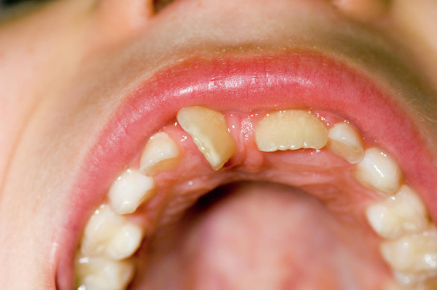 Twisted Front Tooth Photograph by Dr P. Marazzi/science Photo Library