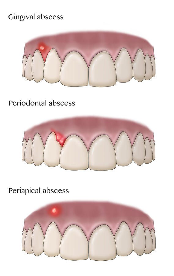Types Of Dental Abscesses, Illustration Photograph by Monica Schroeder